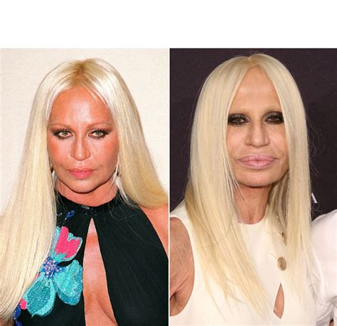 donatella versace plastic surgery 2022.